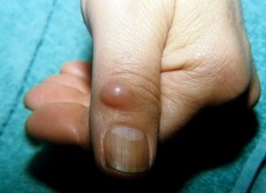 Шишка на пальце руки: причины и лечение