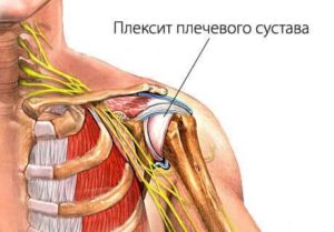 Как лечить остеохондроз плечевого сустава