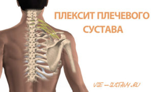 Остеохондроз шейно-плечевого сустава: симптомы заболевания и его лечение