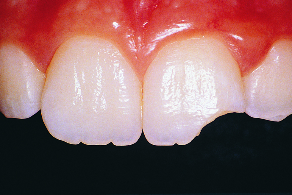 Повреждние зубов