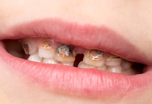 Перечень временных и местных ограничений для имплантации зубов
