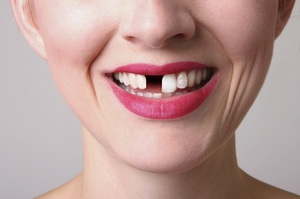 Причины для имплантации зубов