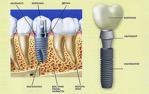 Зубные имплантанты