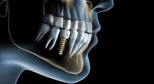 Недостатки зубных имплантов
