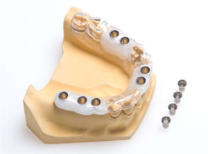 Описание хирургического шаблона и метода его применения в имплантации зубов