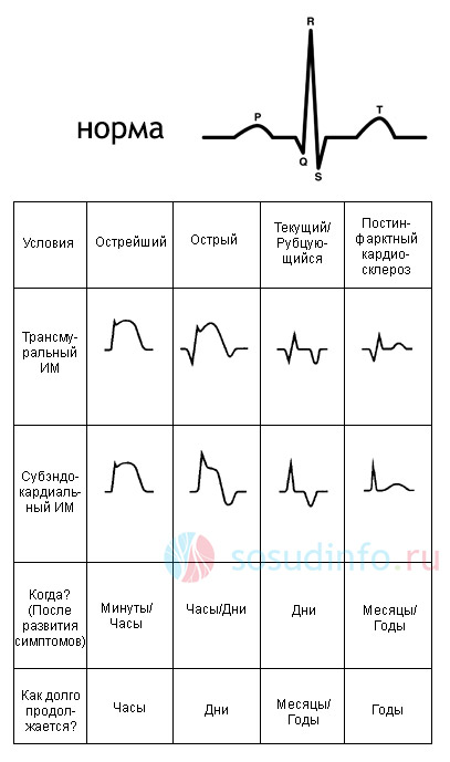 формы инфаркта на ЭКГ