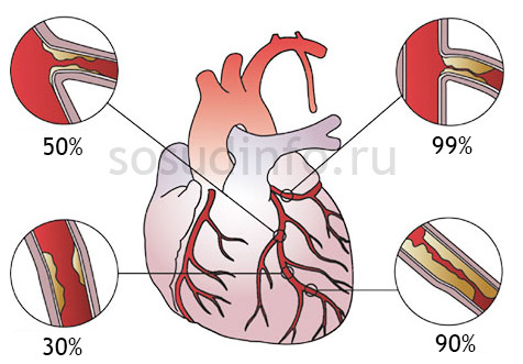 Различные стадии атеросклеротического поражения при сердечной ишемии