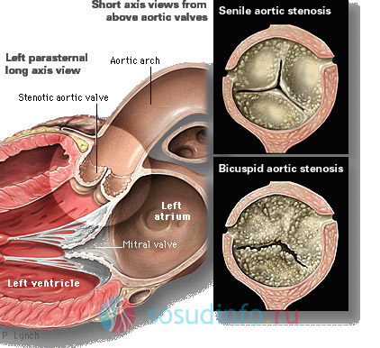 старческий стеноз (сверху) и двустворчатый стеноз (внизу) аортального клапана из-за кальциноза