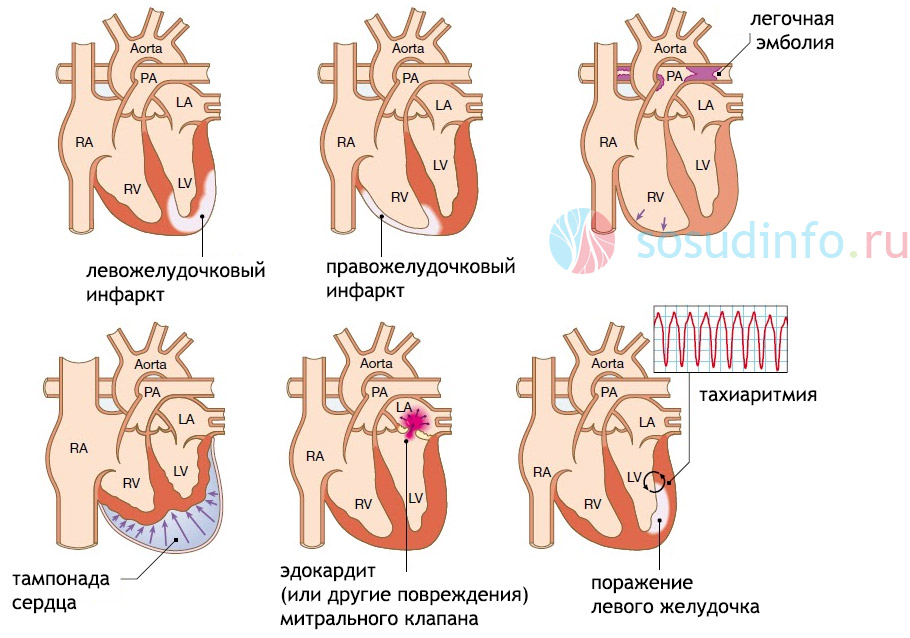 патологии-причины развития кардиогенного шока и их локализация