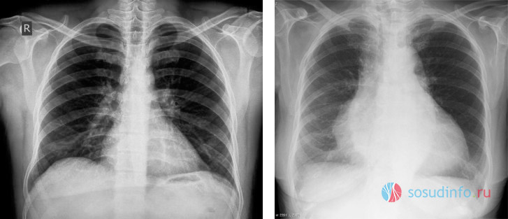 нормальные размеры сердца (слева) и кардиомегалия (справа) на рентгеновском снимке)