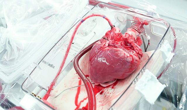 Донорское сердце, готовое к трансплантации
