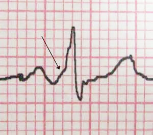 На ЭКГ стрелкой указан характерный признак ВПВ-синдрома – «дельта»-волна в начале желудочкового комплекса