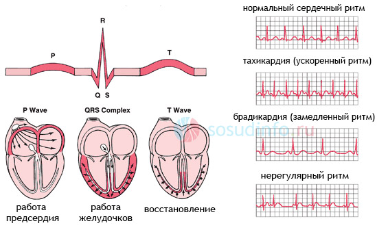 Аритмии - нарушения сердечного ритма на кардиограмме (ЭКГ)