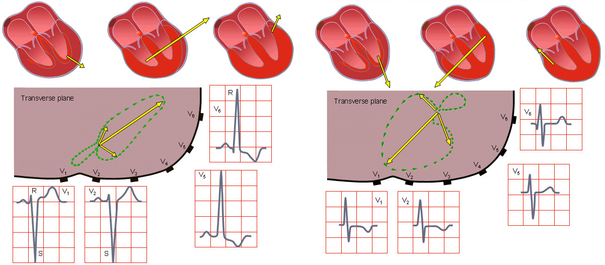 гипертрофия левого (слева) и правого (справа) желудочков на ЭКГ
