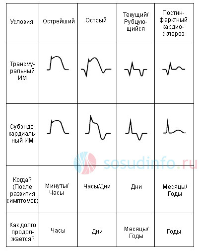 частные формы инфаркта на ЭКГ