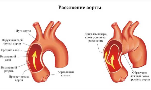 Расслоение аорты
