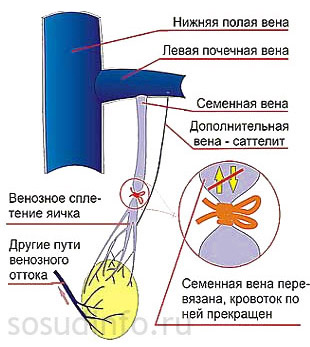 Операция Ивансевича при варикоцеле