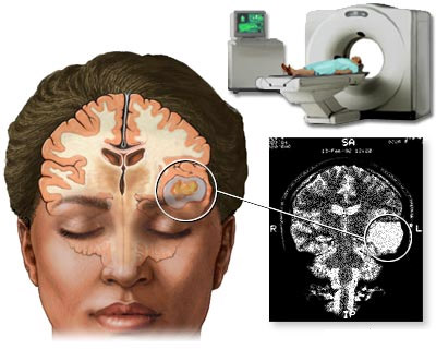 патологический участок мозга на снимке КТ