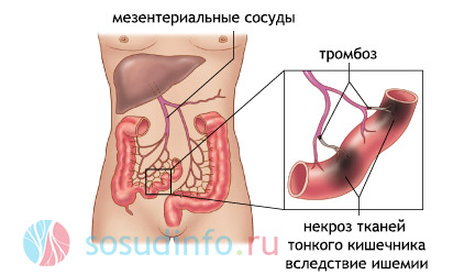 ишемия (инфаркт) кишечника из-за мезентериального тромбоза