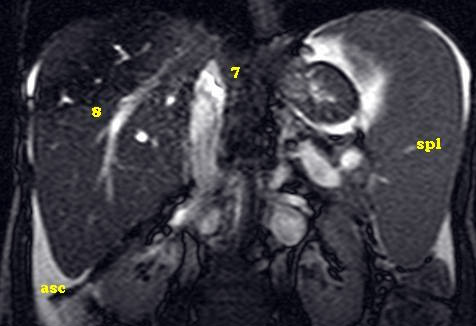Синдром Бадда-Киари, тромбоз вен печени на снимке МРТ
