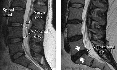 Здоровые позвоночные диски (слева) и межпозвоночная грыжа на МРТ (справа)