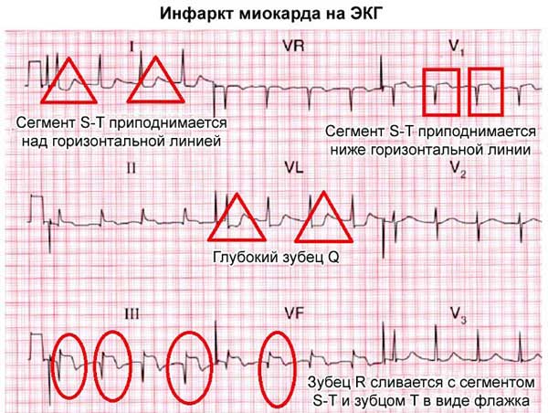 Инфаркт миокарда на ЭКГ