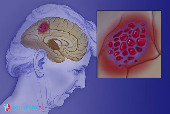гемангиома головного мозга, опухоль сосудов