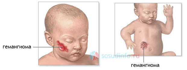 гемангиома на лице и животе у новорожденного