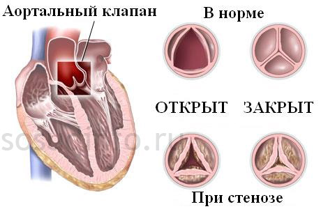  аортальный стеноз