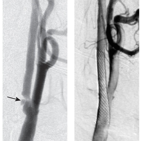 сонная артерия до и после стентирования