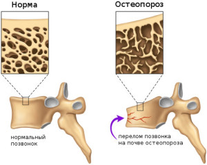 Risunok-5.-Perelom-kosti-porazhennoy-osteoporozom
