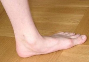 Плокостопие - причина артроза большого пальца ноги