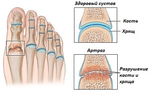 Симптомы артроза большго пальца на ноге