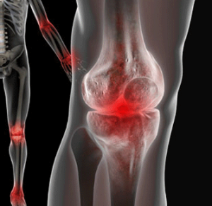 Артроз коленного сустава начльной стадии