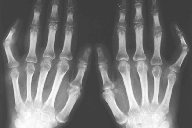 артрит на рентген-снимке