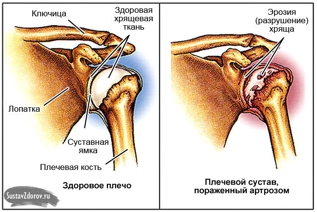 артроз плечевого сустава 