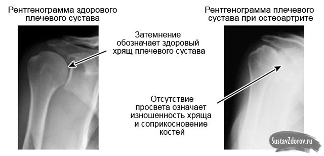 рентгеновский снимок здорового плеча и пораженного артрозом
