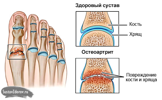остеоартрит сустава большого пальца стопы