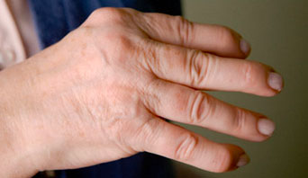 суставы пальцев рук артрит