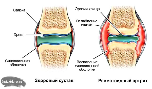 ревматоидный артрит суставов