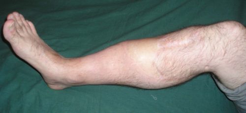 Симптомы ложного сустава на ноге