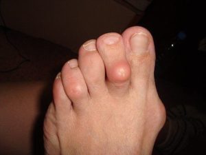 Шишка на пальце ноги