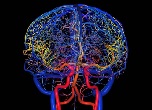 Ангиография сосудов головного мозга