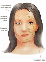 Воспаление лицевого нерва